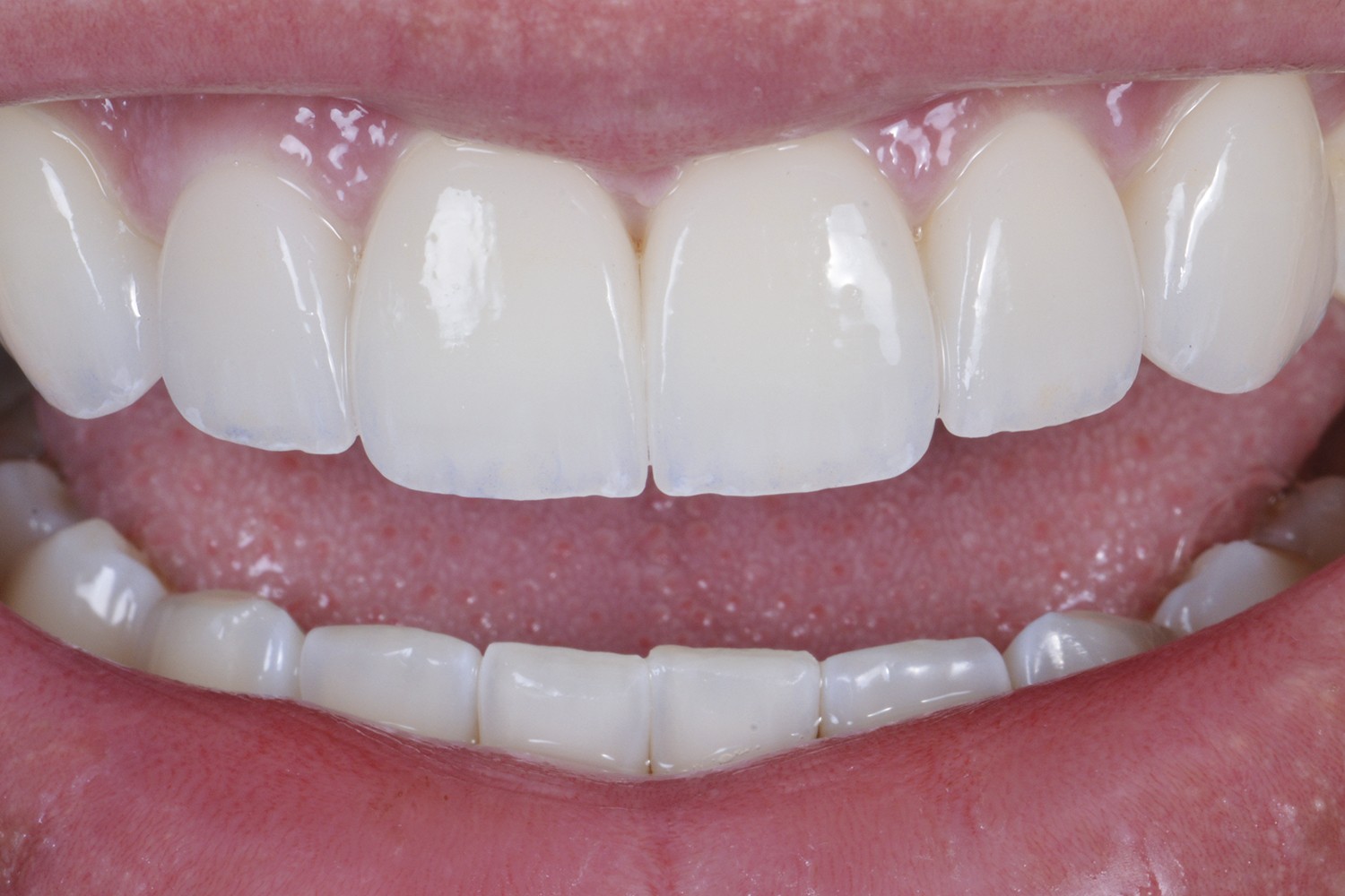 Clareamento dental associado a facetas cerâmicas minimamente invasivas: relato de caso clínico