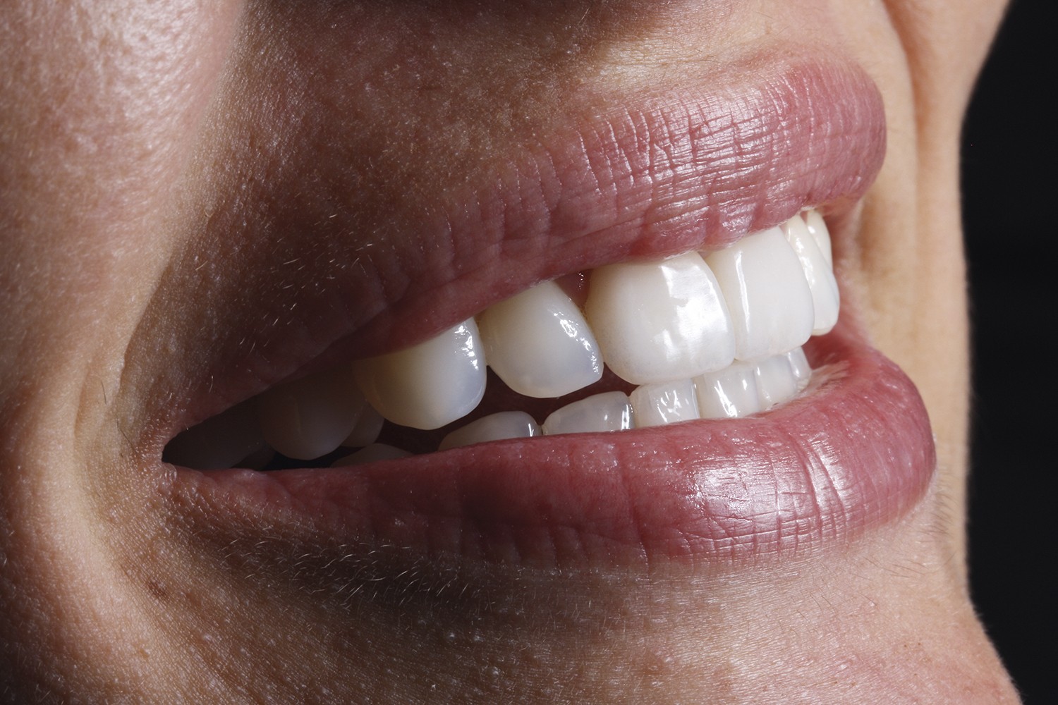 Estética em odontologia: Quando menos é mais