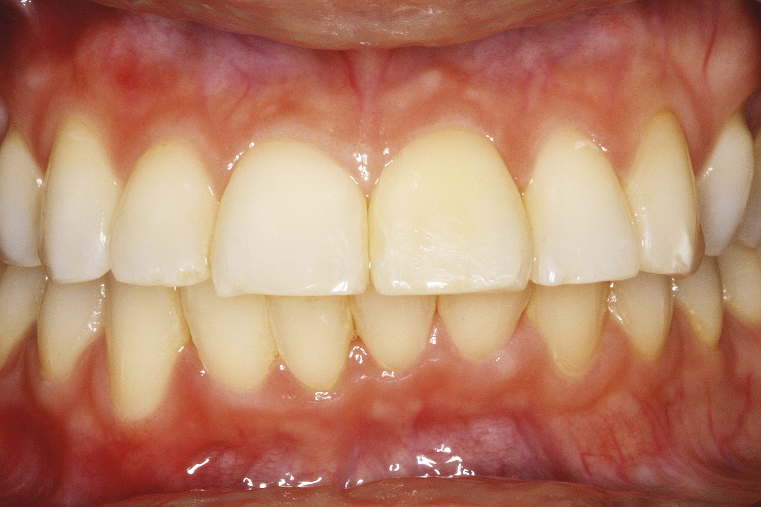 Clareamento Alternativo na Presença de Dente Isolado com Calcificação Pulpar Distrófica