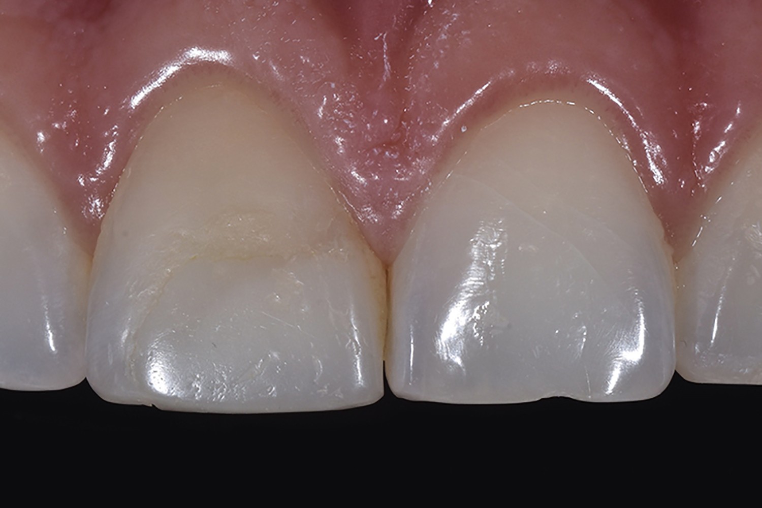 Crown and ceramic veneer: Esthetic solution for traumatized tooth