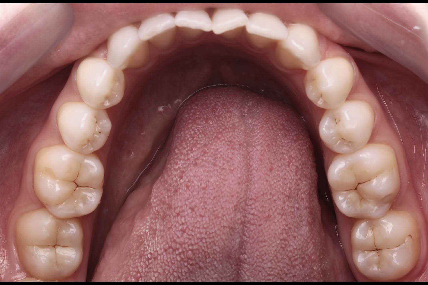Natural Enamel and Dentin Replacement Technique: Simplified Restoration of Posterior Teeth 