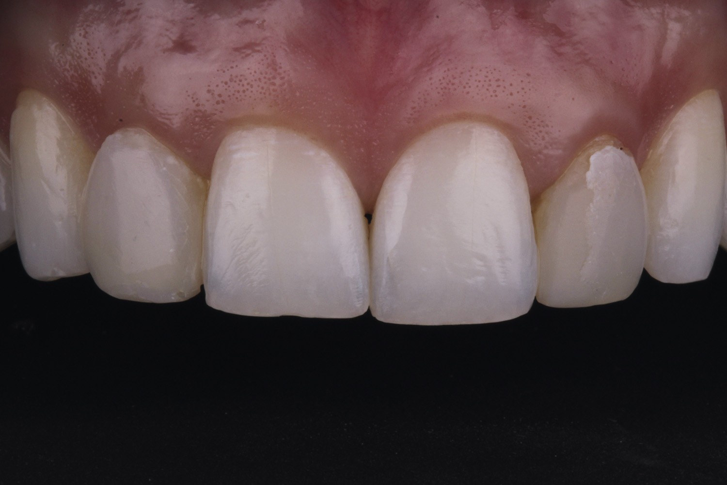 Conoid lateral incisors: aesthetic optimization through the use of ceramic veneers