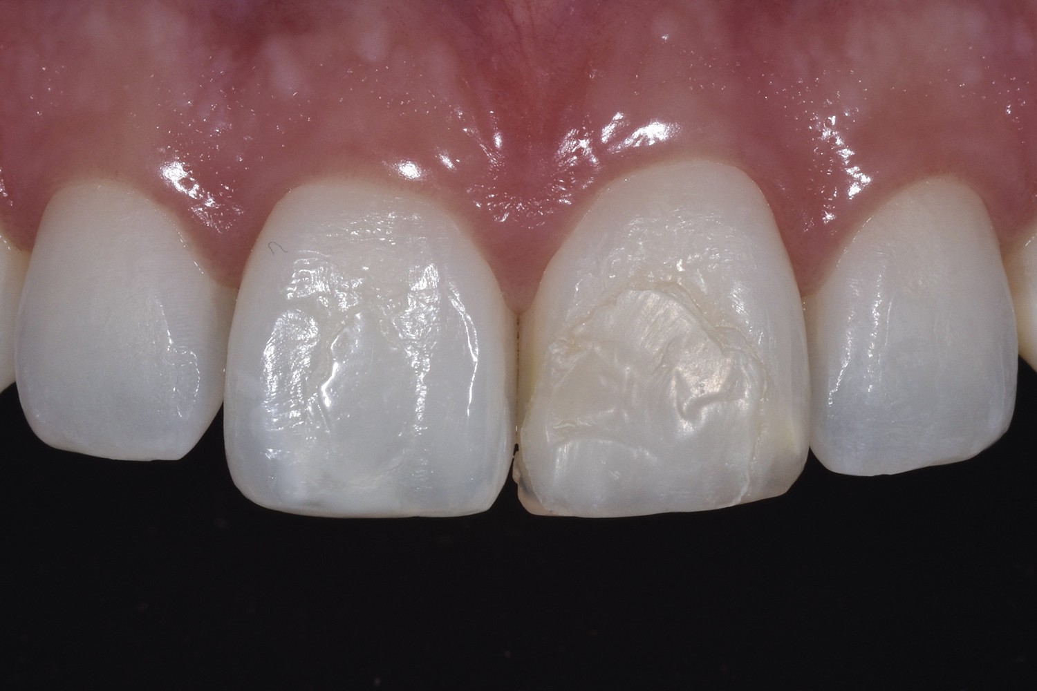 Conservative clinical solutions to molar incisor hypomineralization 
