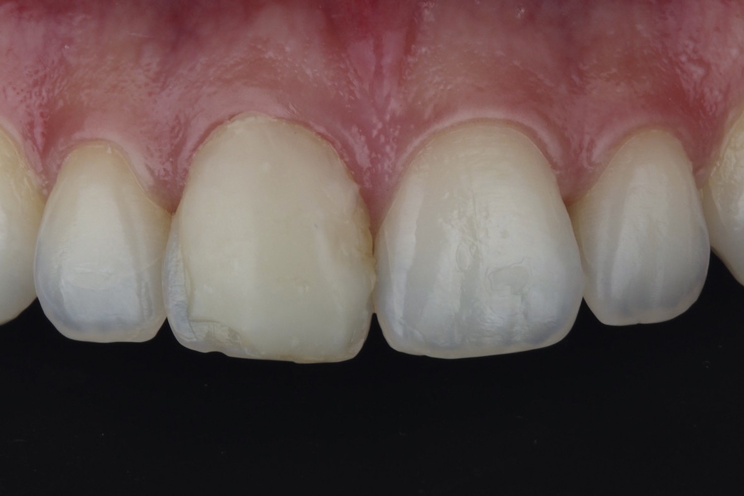 Replacement of single composite resin in a maxillary central incisor: Case report