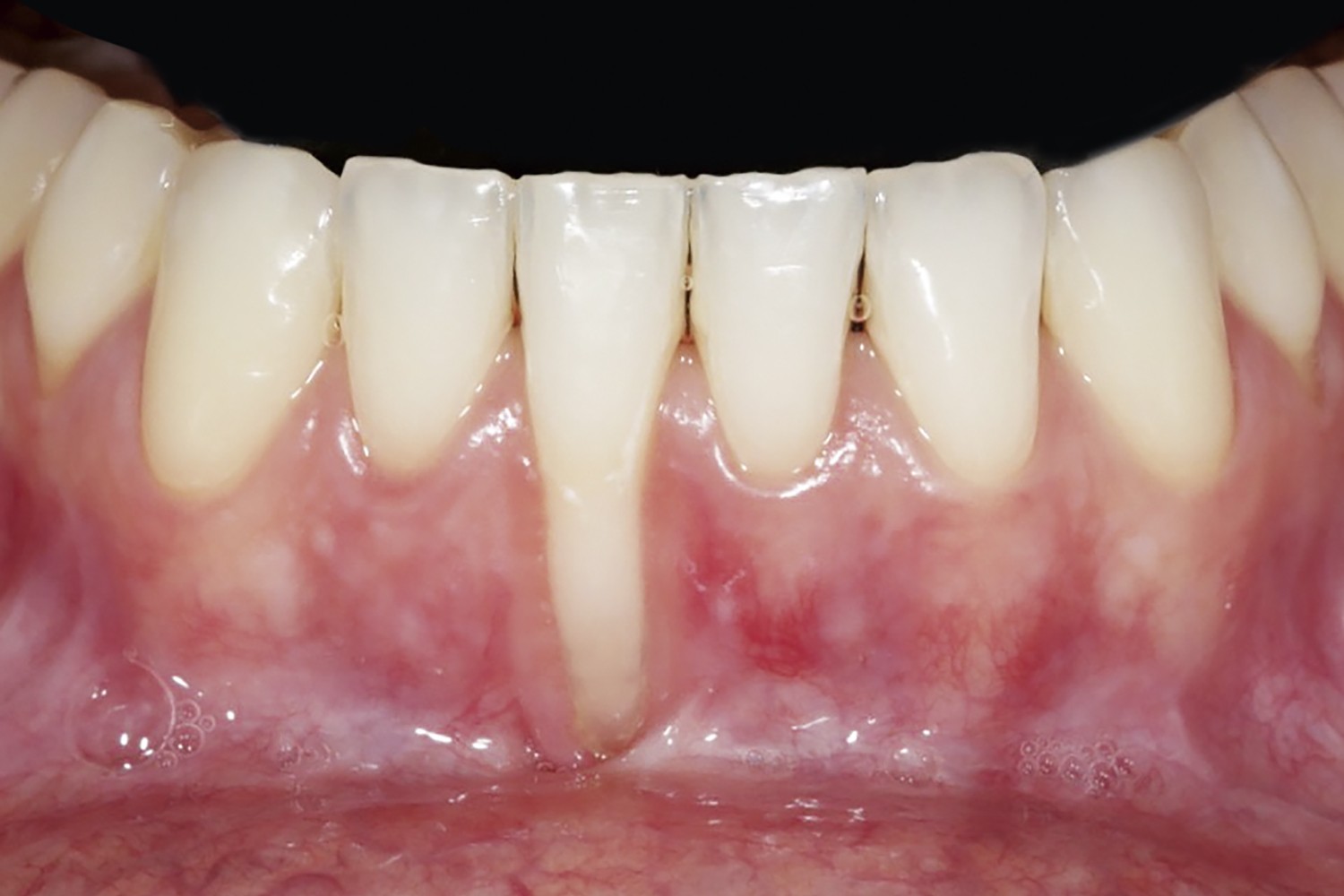 Connective tissue graft for root coverage in anterior mandible using a tunneling technique: Case rep
