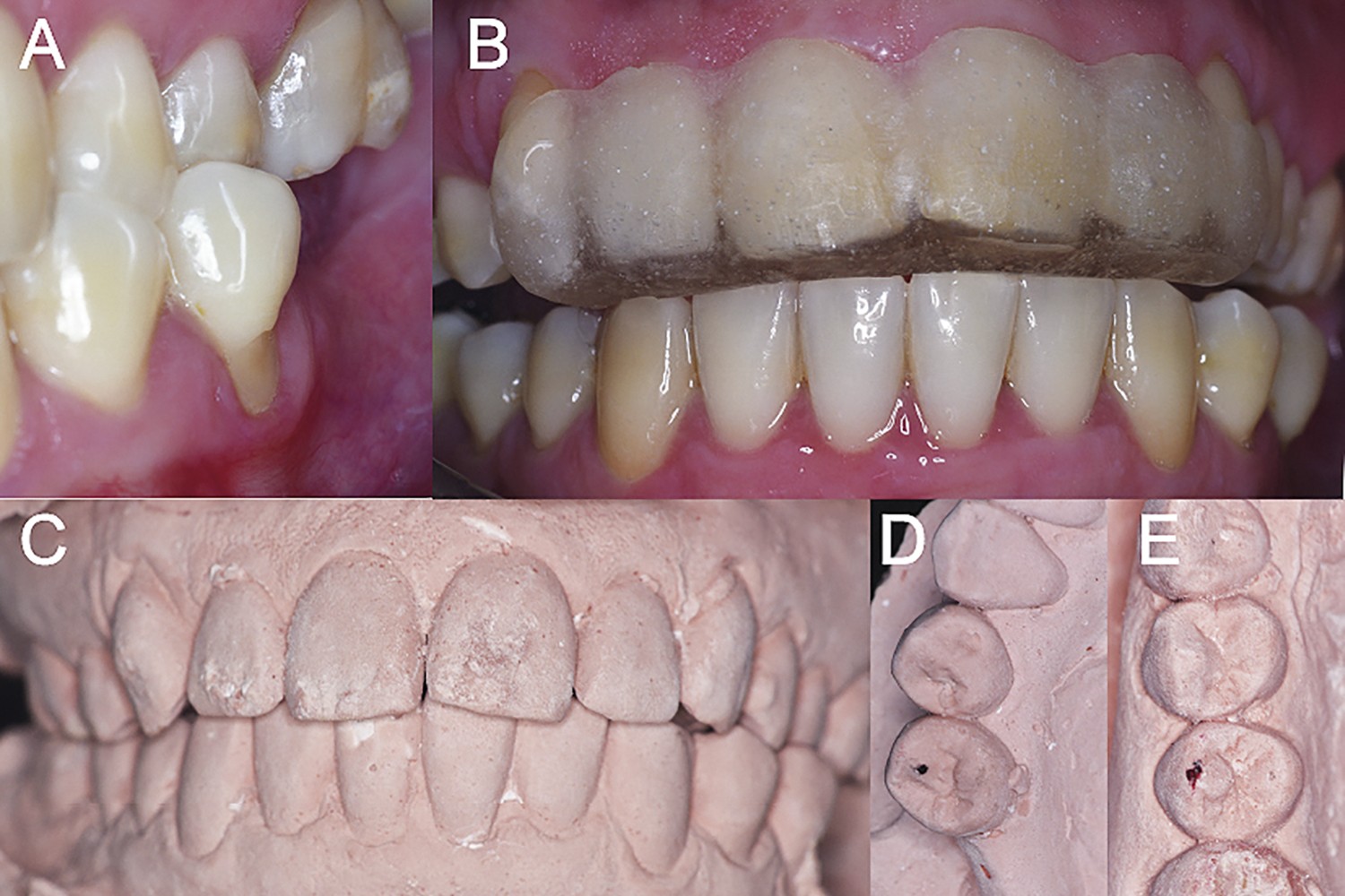 Oclusal trauma as a predisponent risk factor for localized periodontal disease
