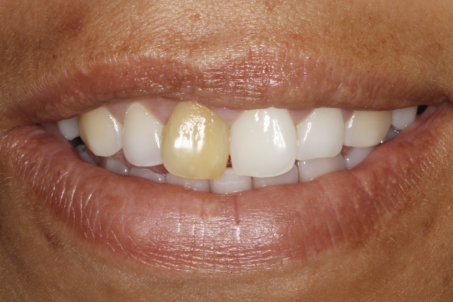 Restoration of dental aesthetics through deflation of dentin technique associated with in-office ble