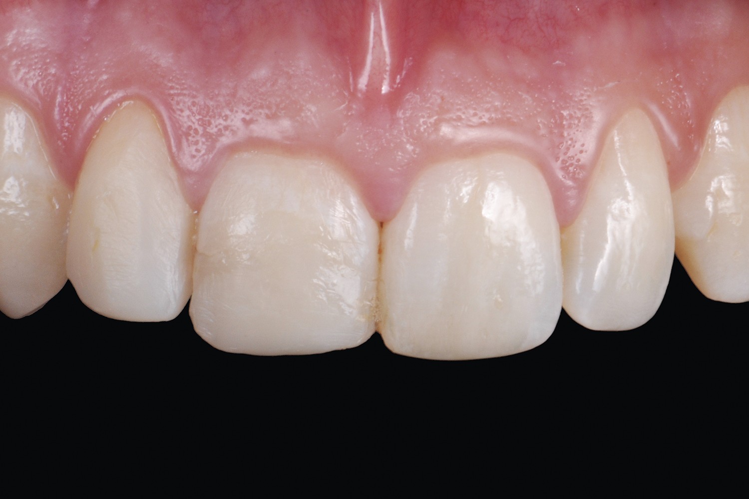 Anterior traumatic dental injuries: Ultra-conservative treatment