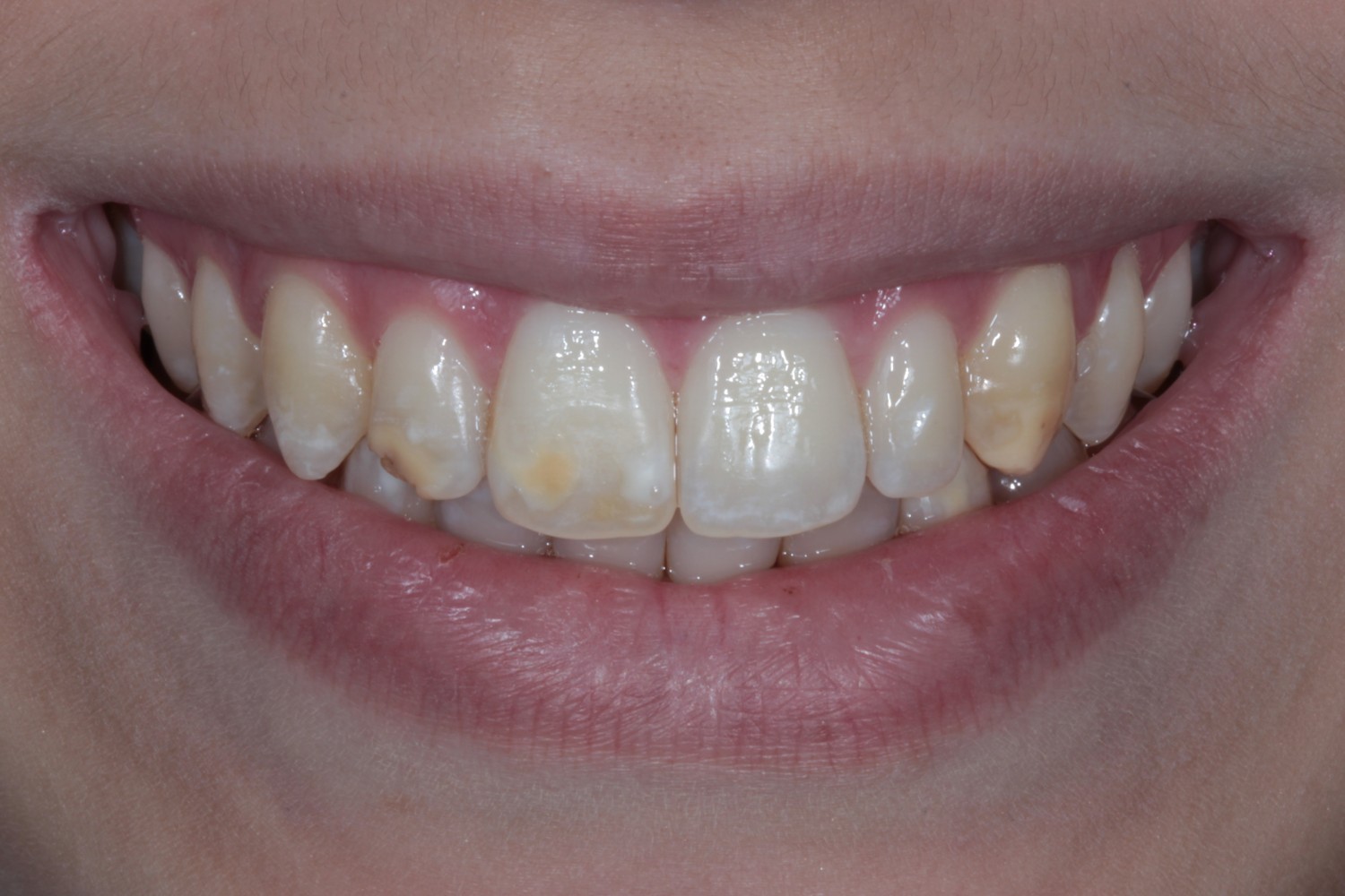 Defectos del desarrollo del esmalte en dentición permanente: evaluación y manejo clínico