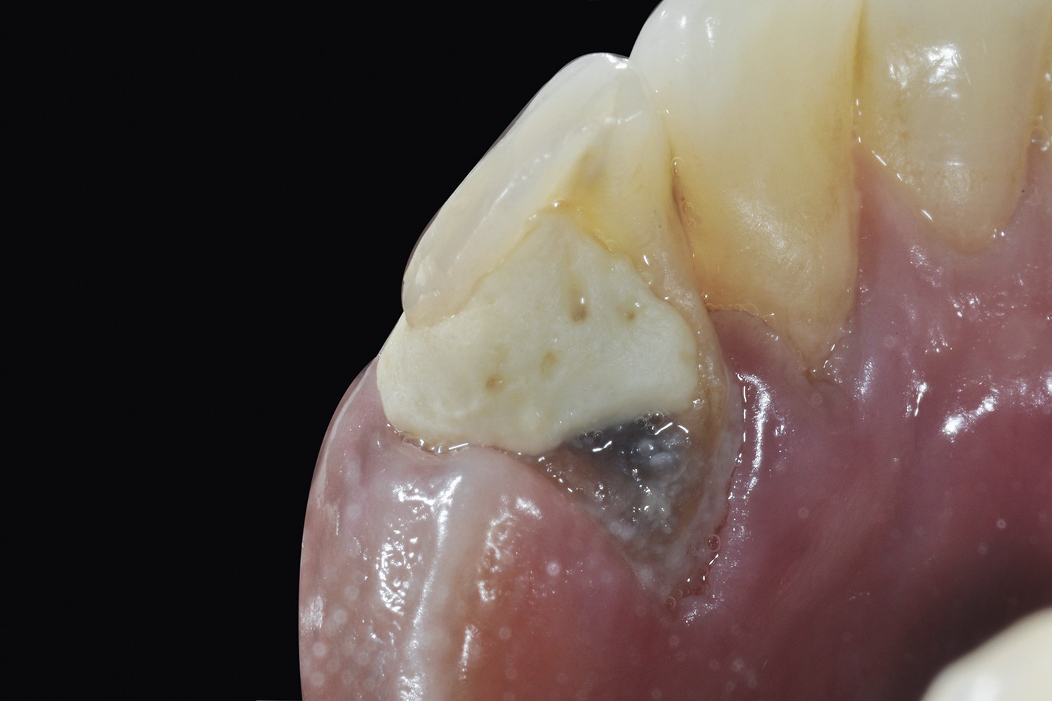 Relevance of the cast metallic posts in a PPR based tooth