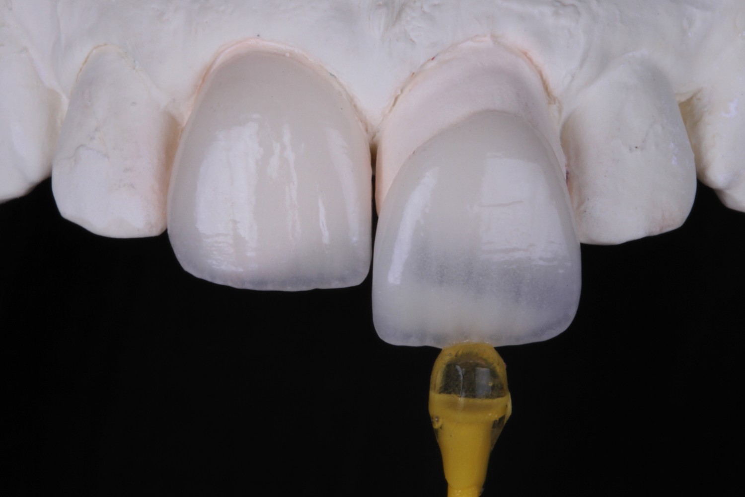 Ultrafine ceramic veneers cemented with preheated resin: a minimally invasive approach