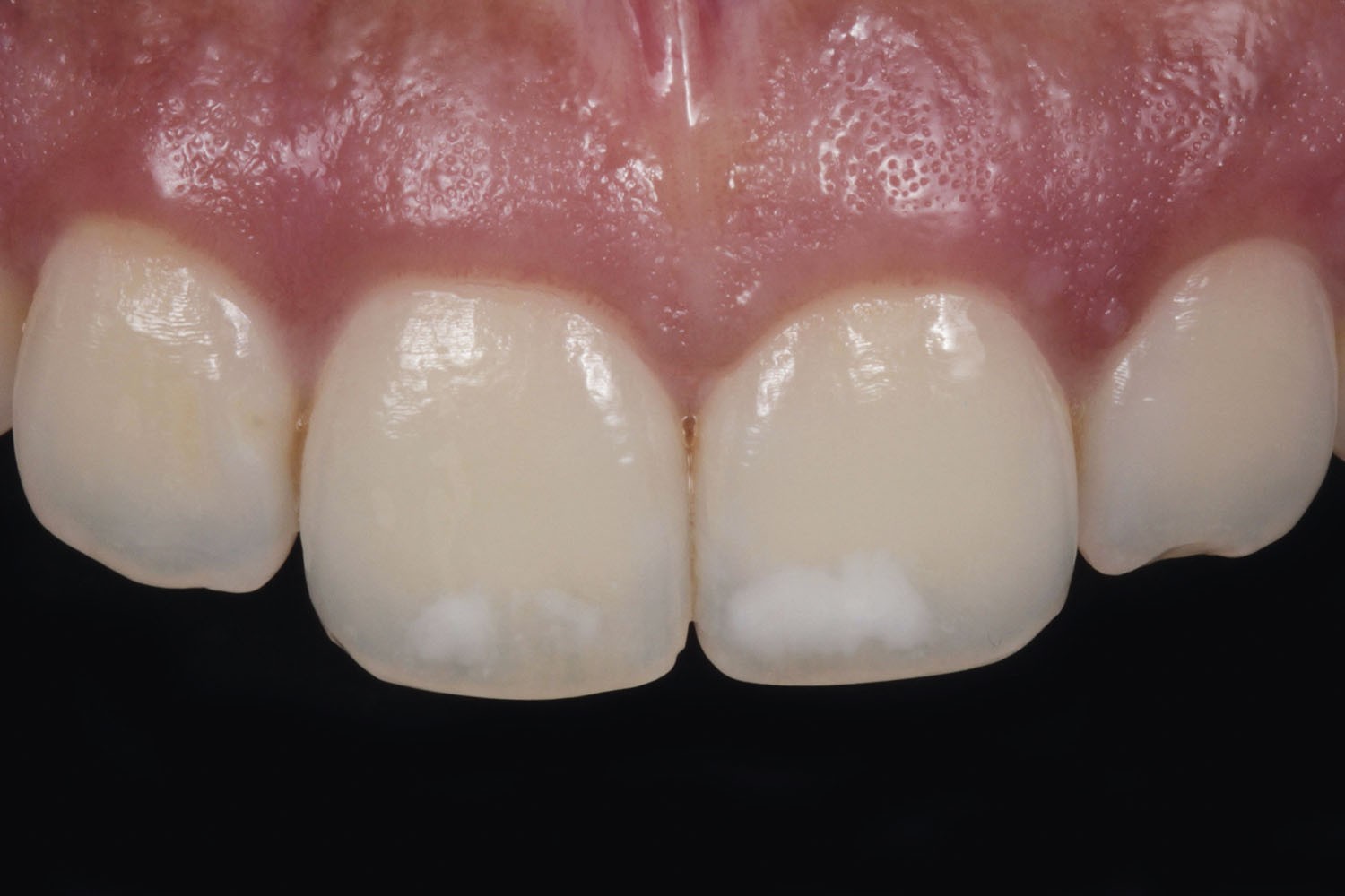 Aesthetic resolution of molar-incisor hypomineralisation lesions: A conservative approach