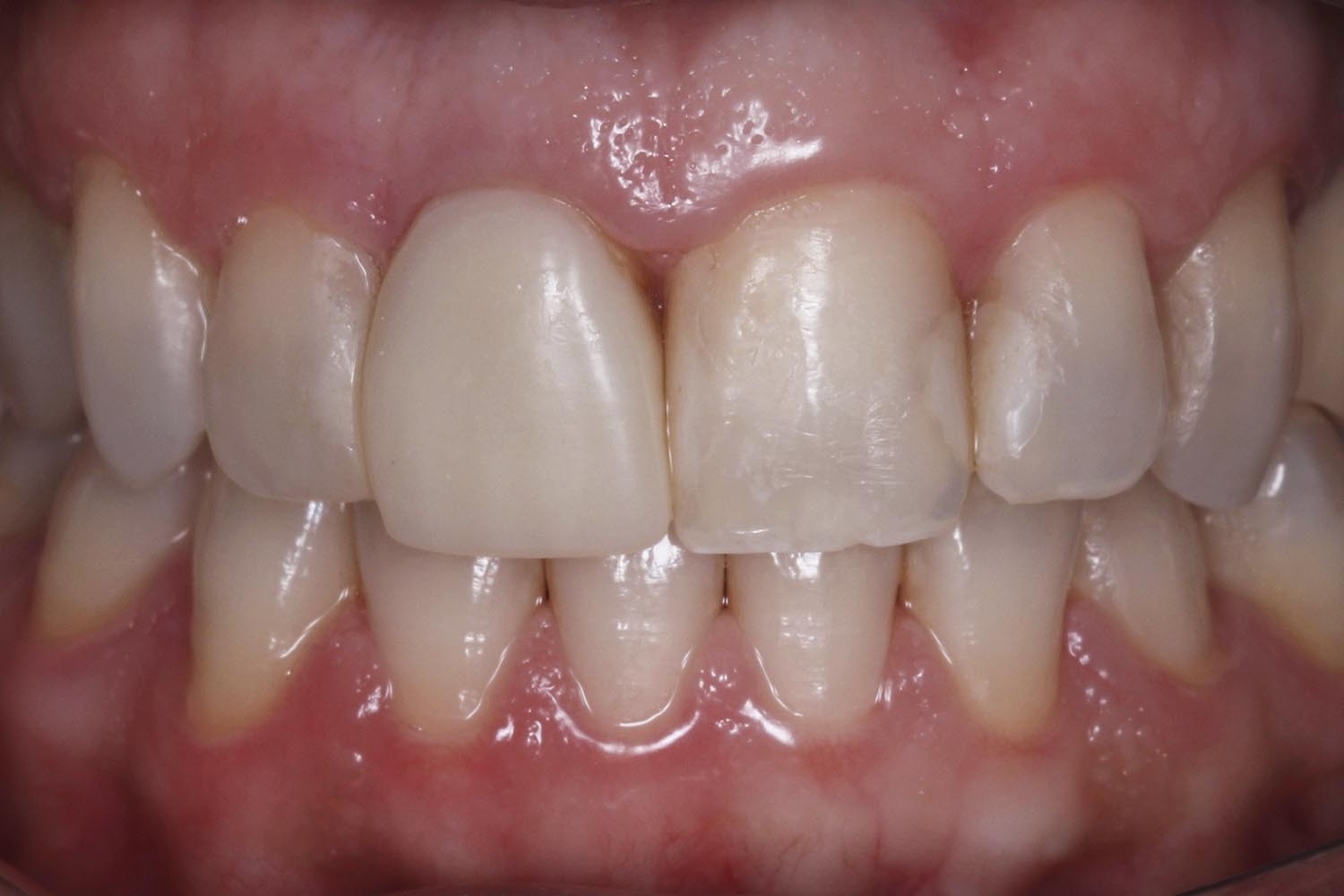 Replacement of a metal post and cementation of ceramic restorations with different thicknesses: A ca