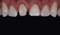 Figura 2: Preparo para coroa do dente 11 e preparo para faceta com redução incisal do dente 21.