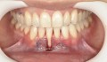 Figura 3: Incisão intrassulcular realizada por microlâmina nos sentidos mesial, distal e apical ao dente, envolvendo a base das papilas proximais para permitir elasticidade para o nível coronal.