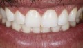Figura 1: Aspecto inicial do sorriso do paciente em que pode ser observada a discrepância entre as proporções dos elementos dentários.