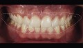 Figuras 5 e 6: Desenho digital com as proporções e formatos dentários mais adequados para o paciente a fim de estabelecer uma harmonia no conjunto de todo o sorriso e desenho digital com a prova dos dentes respectivamente.