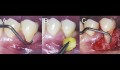 Figura 3: A) Tratamento físico da raiz do dente através de raspagem e alisamento. B) Tratamento químico da raiz do dente com recessão gengival com cloridrato de tetraciclina. C) Curetagem da entrada do ligamento periodontal.