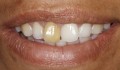 Figura 1. Sorriso inicial evidenciando a pigmentação dentária.