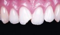 Figuras 1a: Lesões dentais traumáticas anteriores. / Anterior Traumatic Dental Injuries.