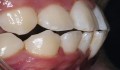 Figura 2: Posicionamento vestibularizado do dente 31.