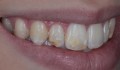 Figuras 1A-1F: Fotografias iniciais de sorriso e intra orais com visão lateral direita, frontal e lateral esquerda. Observa-se a presença de manchas opacas nos dentes ântero-superiores e dentes saturados.