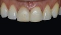 Figura 2. Aspecto intra-oral inicial do sorriso.