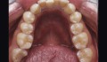 Figura 1a: Aspecto clínico inicial mostrando a fratura do segundo molar direito.