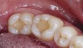 Figura 1: Aspecto inicial das restaurações – dentes 36 e 37.