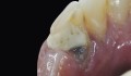 Figura 1: Dente-base. Vista lingual.