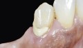 Figura 2: Dente-base. Vista vestibular.