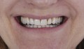 Figura 2: Fotografia frontal do sorriso demonstrando desarmonia de forma e coloração dos dentes.

