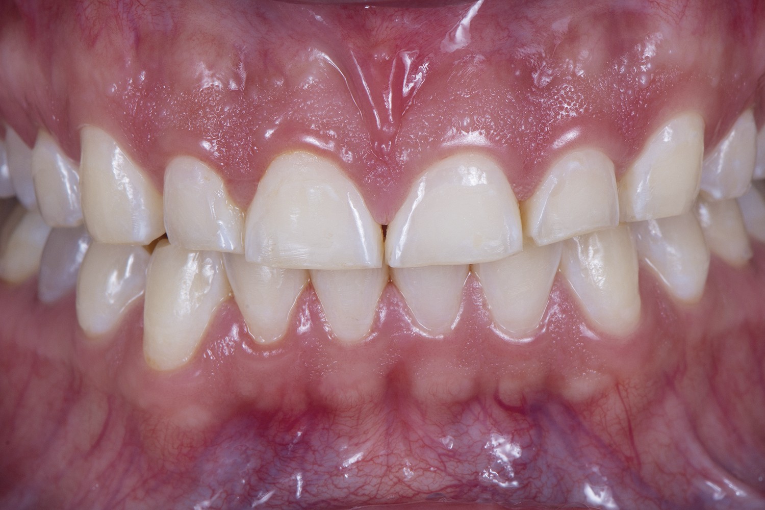 Resina Flow Injetada: Restaurações Transitórias sem Preparo Dental