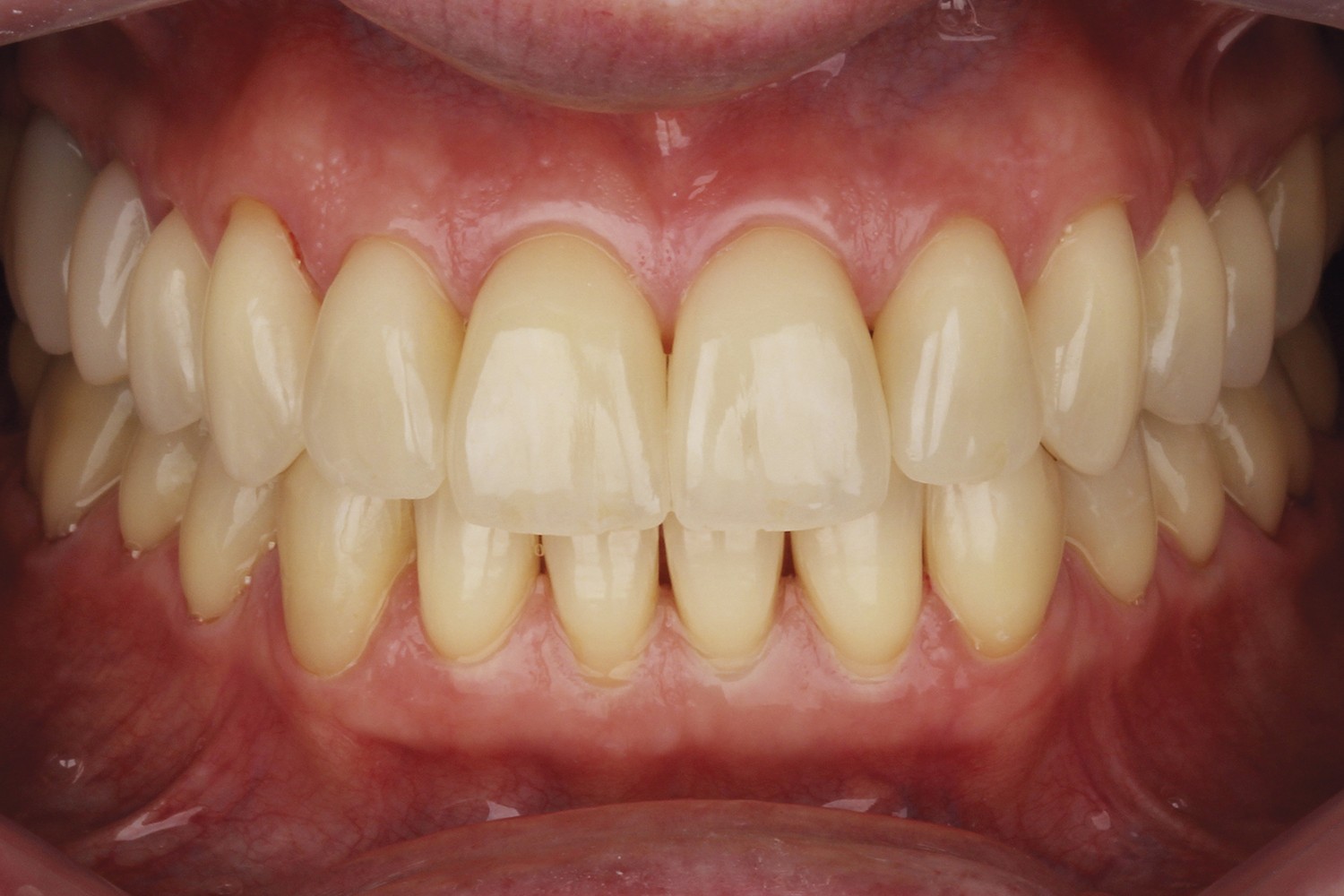 Natural enamel and dentin replacement technique with the 2 and 2 Concept