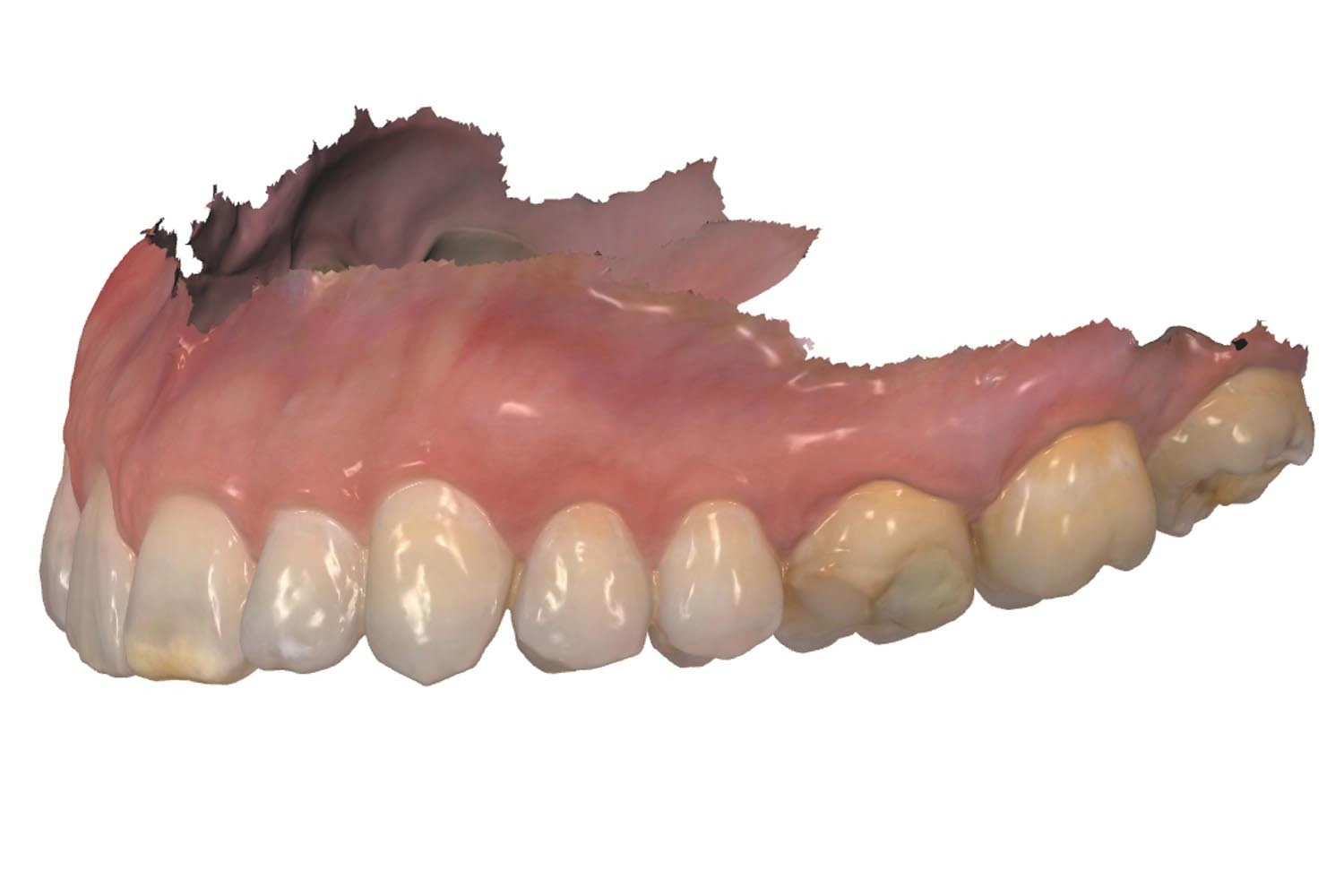Composite Resin Blocks for CAD/CAM - Maximizing Adhesion Concepts through Digital Dentistry (Part I)