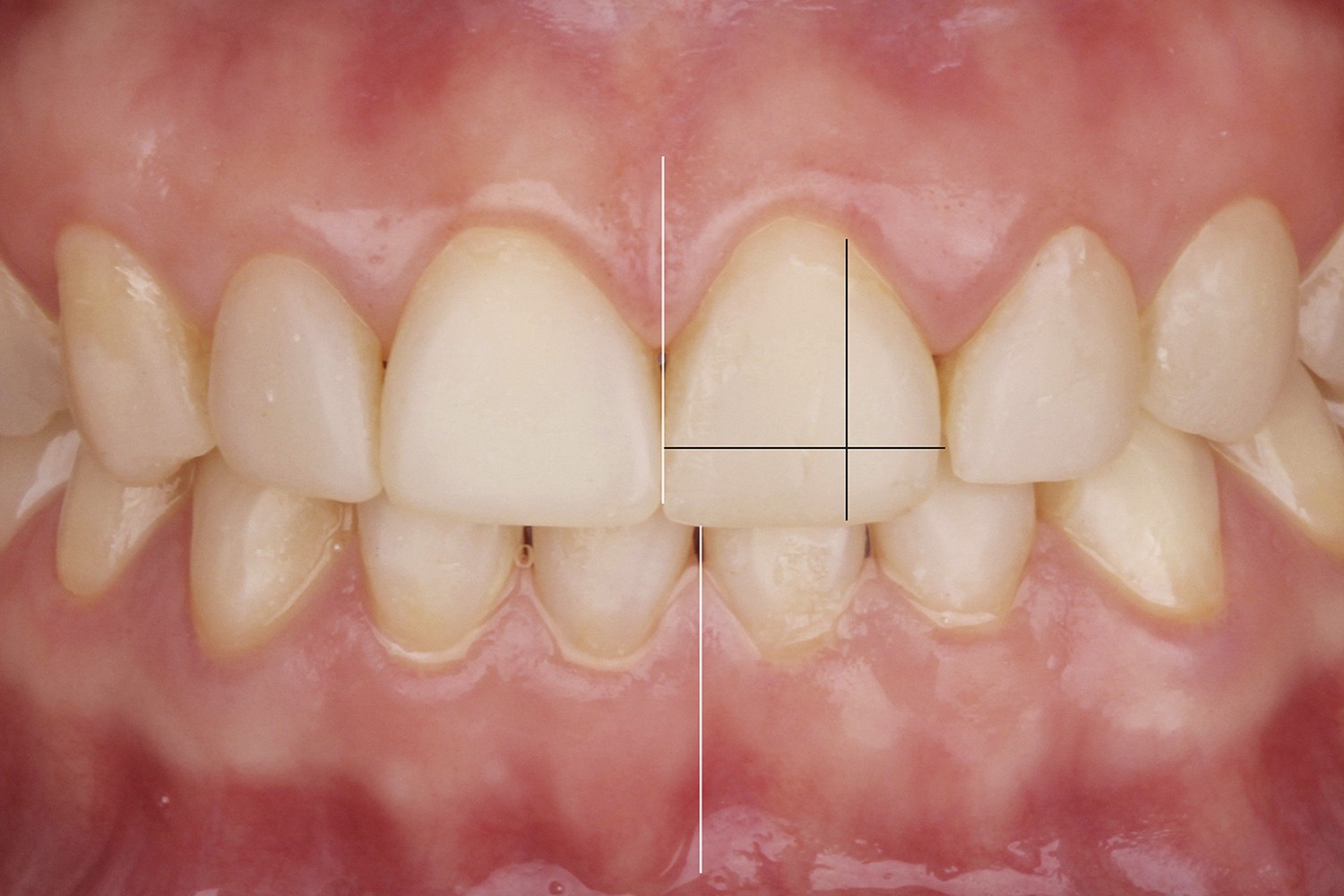 A Novel Concept in Oral Rehabilitation: 2 and 2 CONCEPT